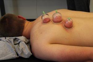 cupping clinic